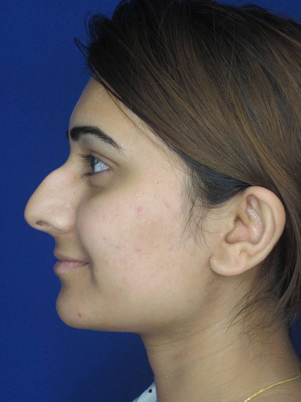 Rhinoplasty Before & After Gallery - Patient 165416668 - Image 9
