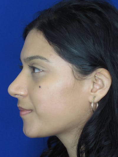 Rhinoplasty Before & After Gallery - Patient 121695955 - Image 6