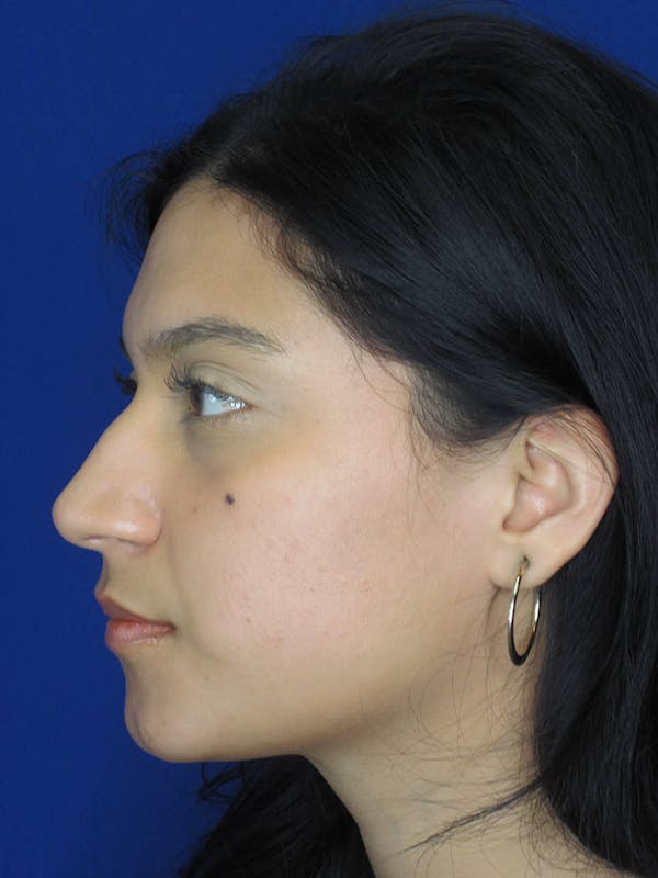 Rhinoplasty Before & After Gallery - Patient 121695955 - Image 5
