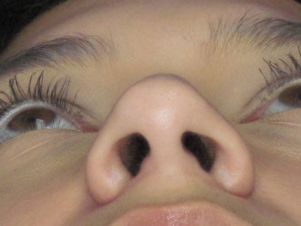 Rhinoplasty Before & After Gallery - Patient 121695955 - Image 7