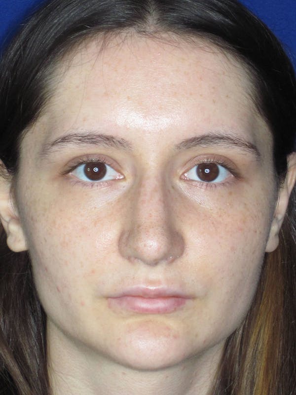 Rhinoplasty Before & After Gallery - Patient 121695956 - Image 2
