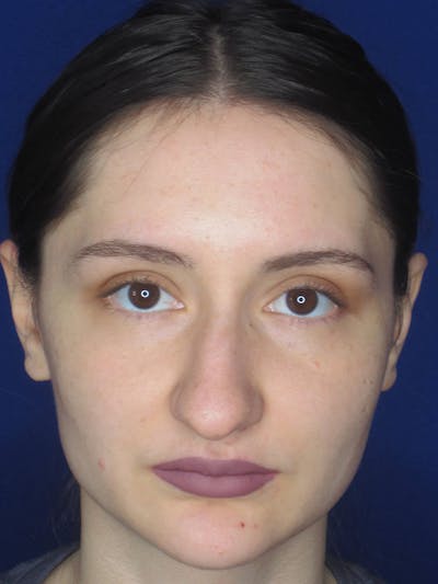 Rhinoplasty Before & After Gallery - Patient 121695956 - Image 1