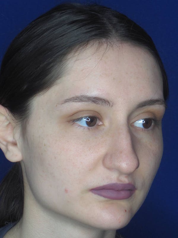 Rhinoplasty Before & After Gallery - Patient 121695956 - Image 3