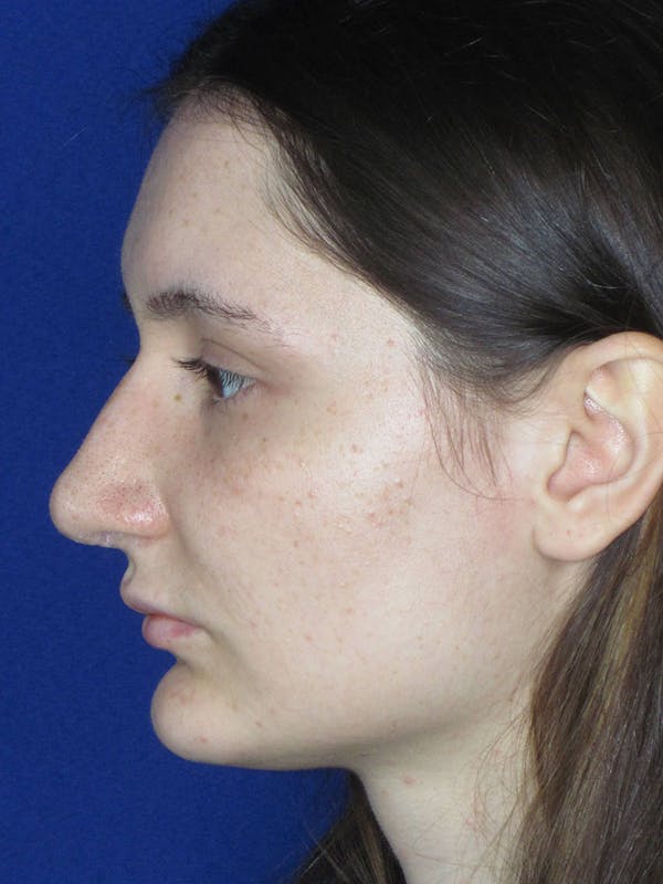 Rhinoplasty Before & After Gallery - Patient 121695956 - Image 6