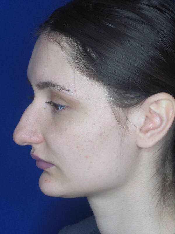 Rhinoplasty Before & After Gallery - Patient 121695956 - Image 5