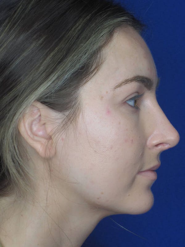 Rhinoplasty Before & After Gallery - Patient 121695993 - Image 2