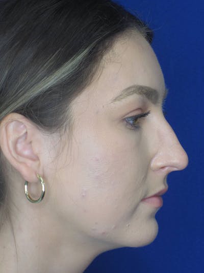 Rhinoplasty Before & After Gallery - Patient 121695993 - Image 1