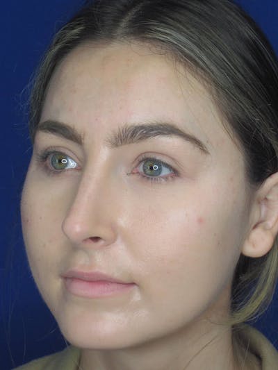 Rhinoplasty Before & After Gallery - Patient 121695993 - Image 4