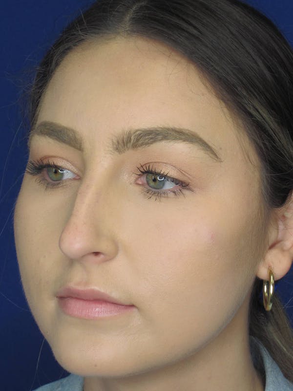 Rhinoplasty Before & After Gallery - Patient 121695993 - Image 3