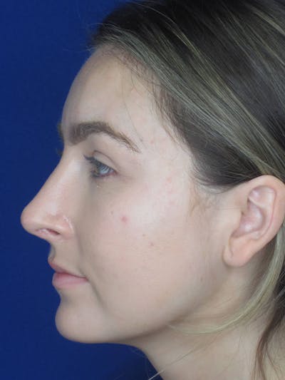Rhinoplasty Before & After Gallery - Patient 121695993 - Image 6