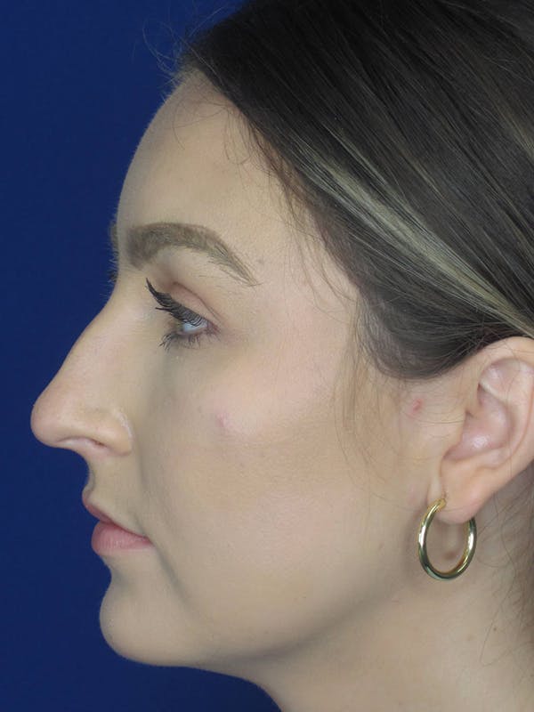 Rhinoplasty Before & After Gallery - Patient 121695993 - Image 5