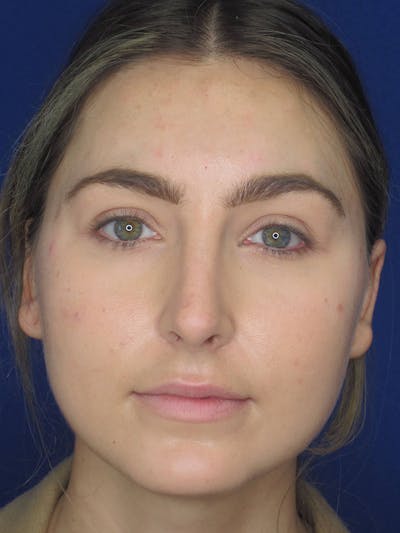 Rhinoplasty Before & After Gallery - Patient 121695993 - Image 8