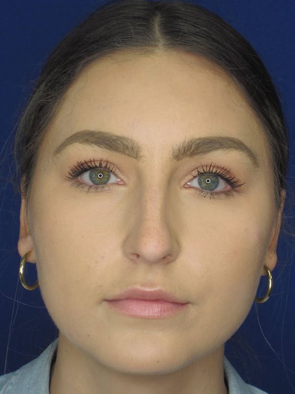 Rhinoplasty Before & After Gallery - Patient 121695993 - Image 7