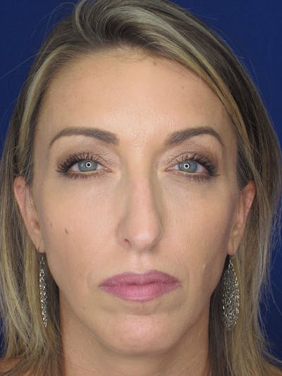Rhinoplasty Before & After Gallery - Patient 121695994 - Image 1