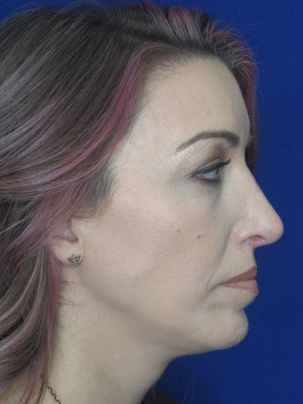 Rhinoplasty Before & After Gallery - Patient 121695994 - Image 4