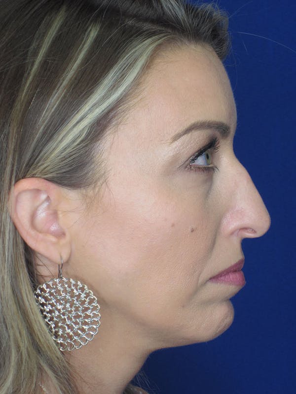 Rhinoplasty Before & After Gallery - Patient 121695994 - Image 3