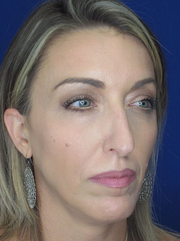 Rhinoplasty Before & After Gallery - Patient 121695994 - Image 5