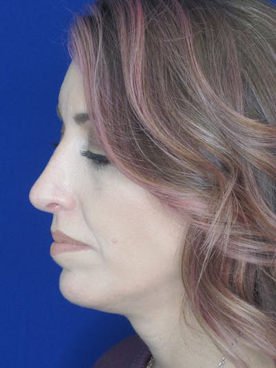 Rhinoplasty Before & After Gallery - Patient 121695994 - Image 8