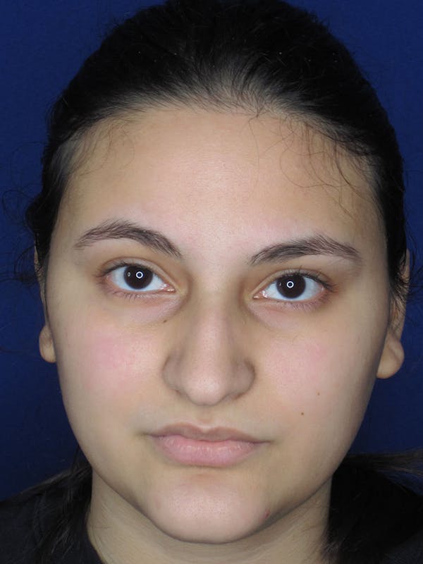 Rhinoplasty Before & After Gallery - Patient 121695995 - Image 1