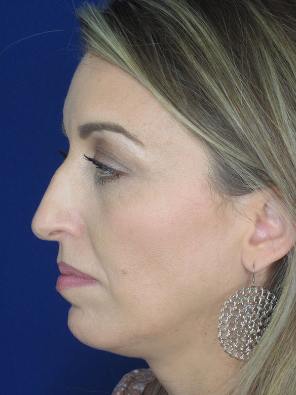 Rhinoplasty Before & After Gallery - Patient 121695994 - Image 7