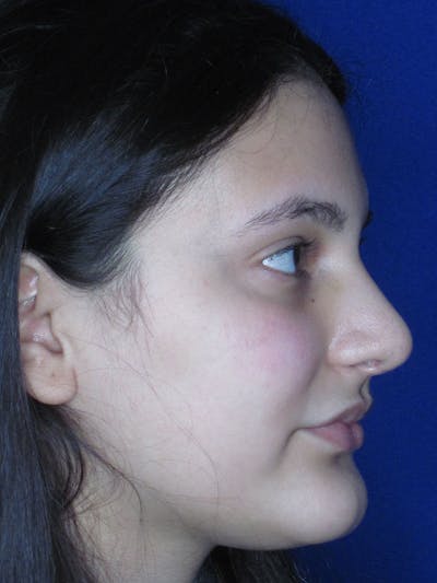 Rhinoplasty Before & After Gallery - Patient 121695995 - Image 4