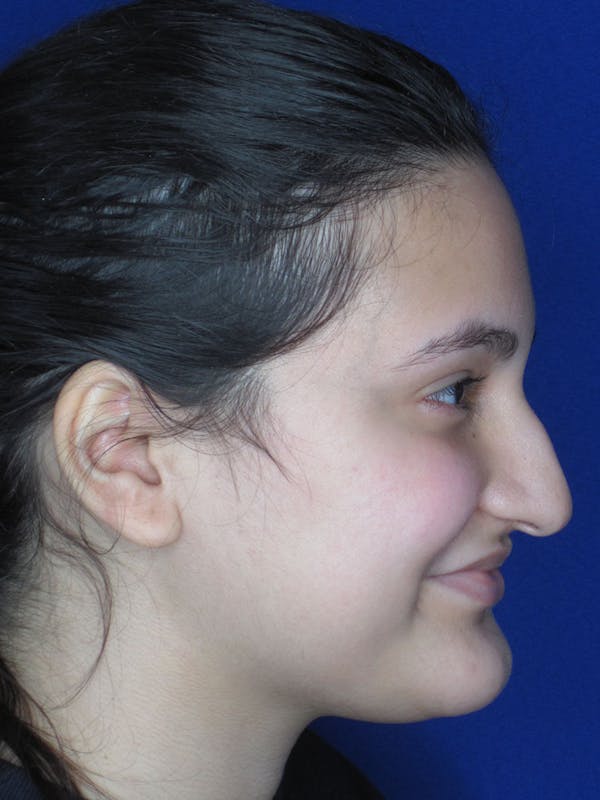 Rhinoplasty Before & After Gallery - Patient 121695995 - Image 3