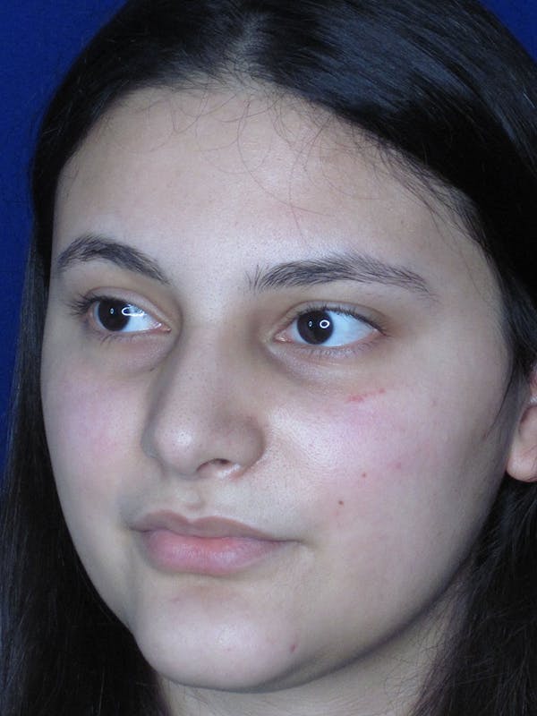 Rhinoplasty Before & After Gallery - Patient 121695995 - Image 6