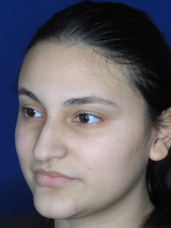 Rhinoplasty Before & After Gallery - Patient 121695995 - Image 5