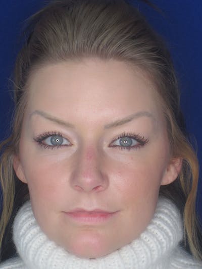 Rhinoplasty Before & After Gallery - Patient 121696017 - Image 2
