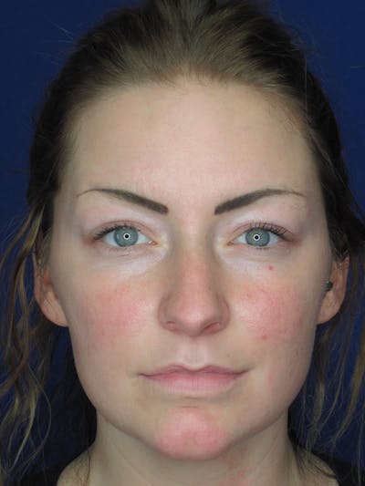 Rhinoplasty Before & After Gallery - Patient 121696017 - Image 1