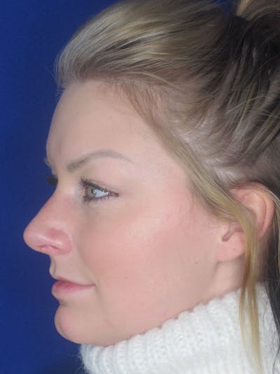 Rhinoplasty Before & After Gallery - Patient 121696017 - Image 4