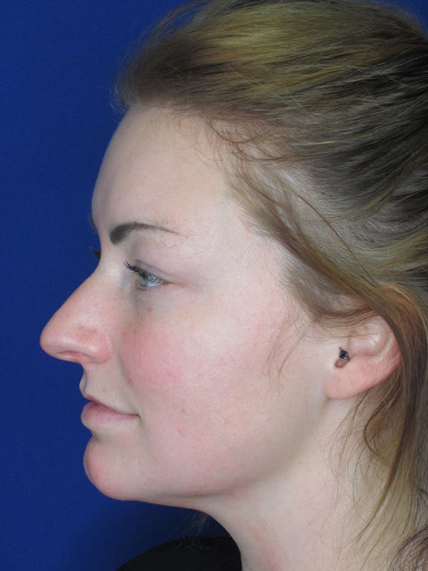 Rhinoplasty Before & After Gallery - Patient 121696017 - Image 3