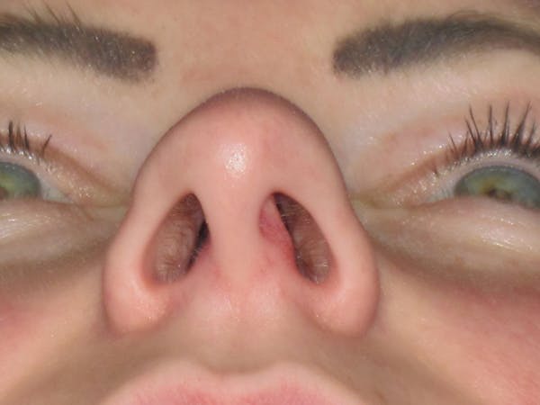 Rhinoplasty Before & After Gallery - Patient 121696017 - Image 7