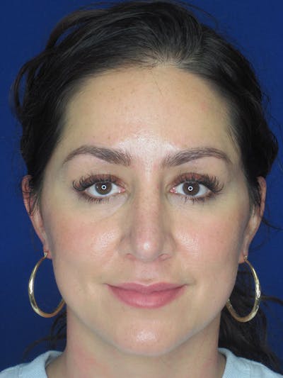 Rhinoplasty Before & After Gallery - Patient 121696018 - Image 2