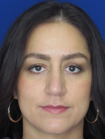 Rhinoplasty Before & After Gallery - Patient 121696018 - Image 1