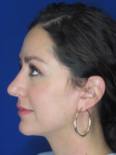 Rhinoplasty Before & After Gallery - Patient 121696018 - Image 4