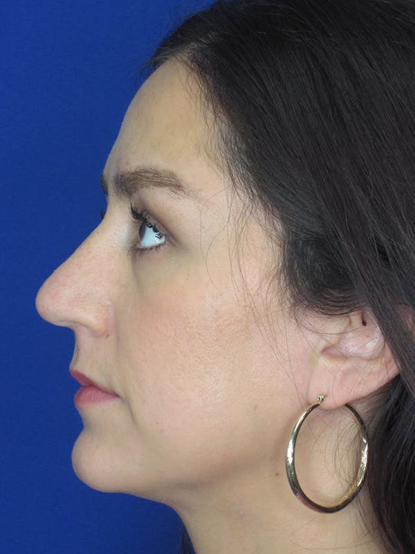 Rhinoplasty Before & After Gallery - Patient 121696018 - Image 3