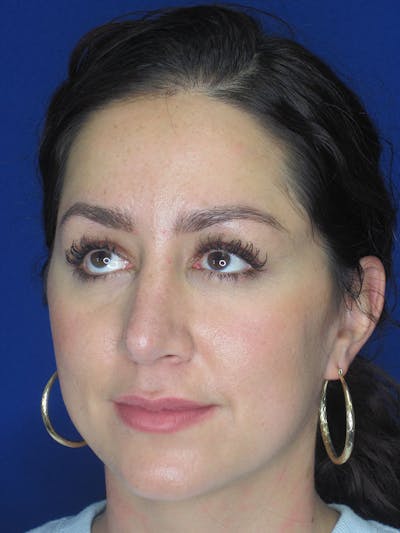 Rhinoplasty Before & After Gallery - Patient 121696018 - Image 6