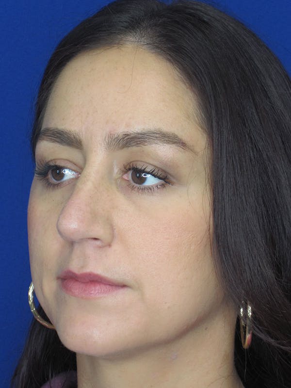 Rhinoplasty Before & After Gallery - Patient 121696018 - Image 5
