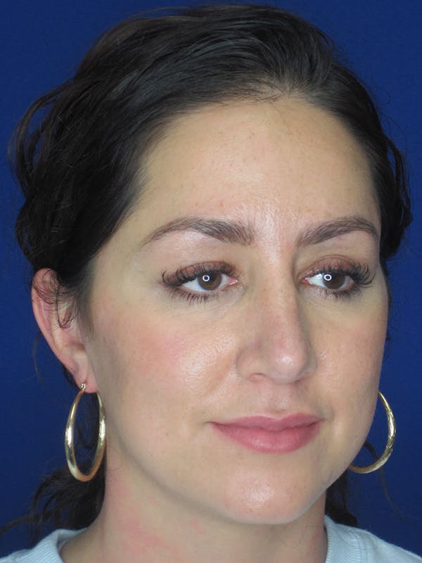 Rhinoplasty Before & After Gallery - Patient 121696018 - Image 8