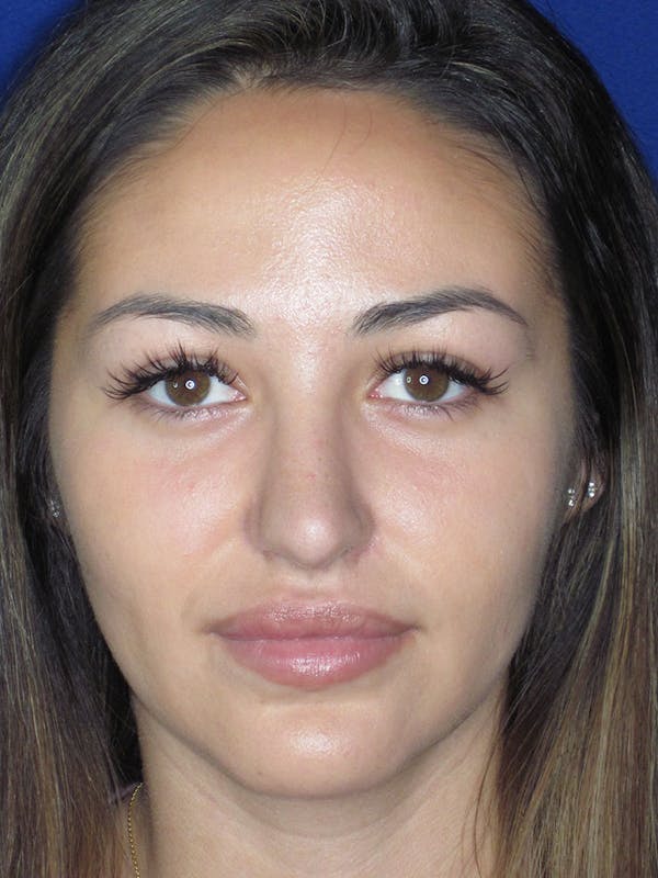 Rhinoplasty Before & After Gallery - Patient 121696019 - Image 2