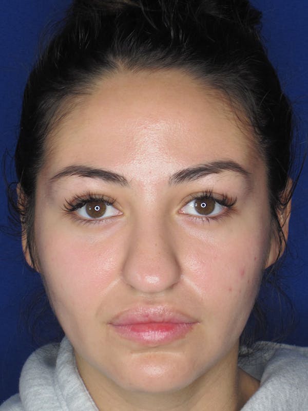 Rhinoplasty Before & After Gallery - Patient 121696019 - Image 1
