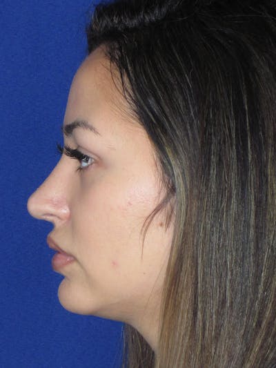 Rhinoplasty Before & After Gallery - Patient 121696019 - Image 4