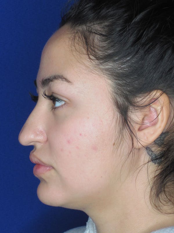 Rhinoplasty Before & After Gallery - Patient 121696019 - Image 3