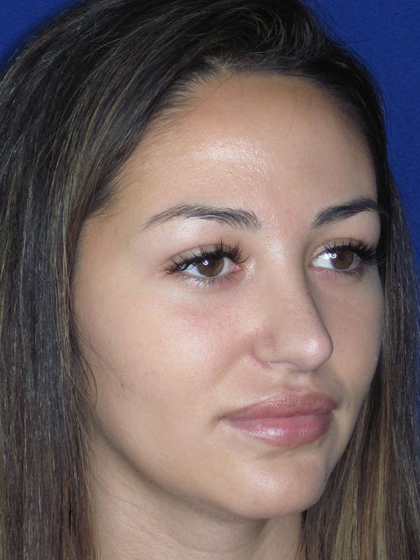 Rhinoplasty Before & After Gallery - Patient 121696019 - Image 6