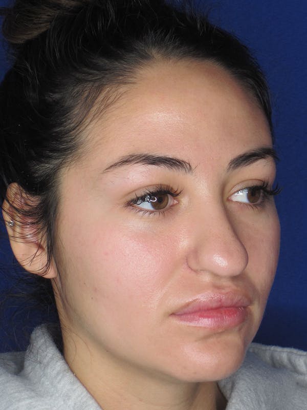 Rhinoplasty Before & After Gallery - Patient 121696019 - Image 5