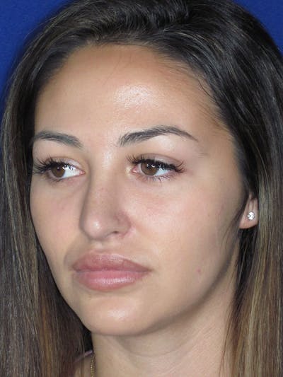 Rhinoplasty Before & After Gallery - Patient 121696019 - Image 8