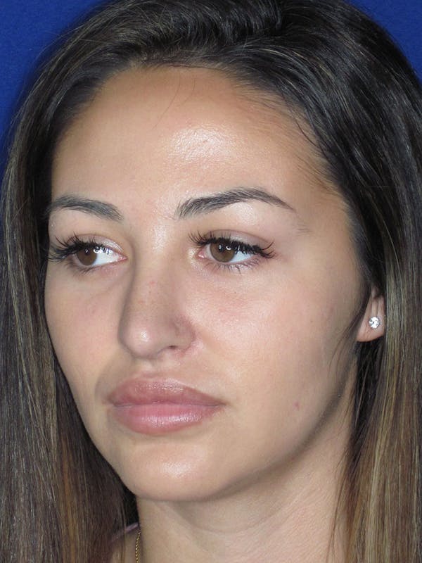 Rhinoplasty Before & After Gallery - Patient 121696019 - Image 8