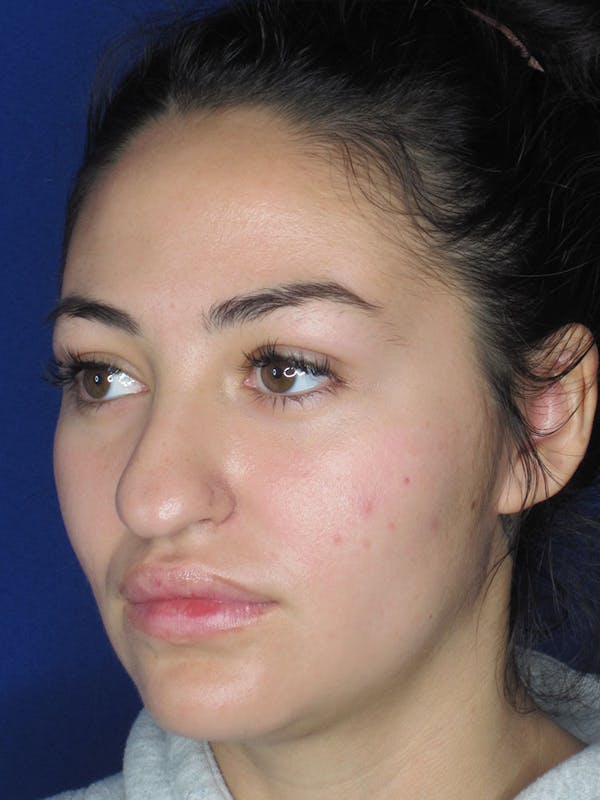 Rhinoplasty Before & After Gallery - Patient 121696019 - Image 7