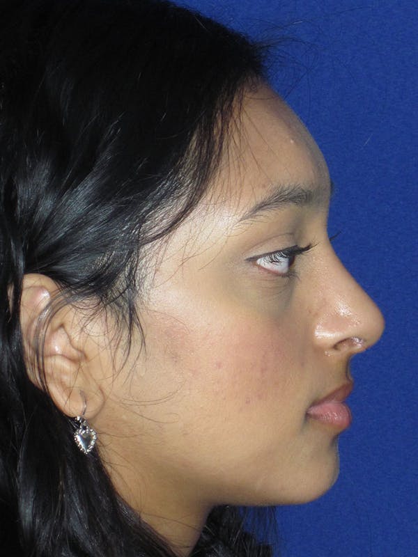 Rhinoplasty Before & After Gallery - Patient 121696020 - Image 2